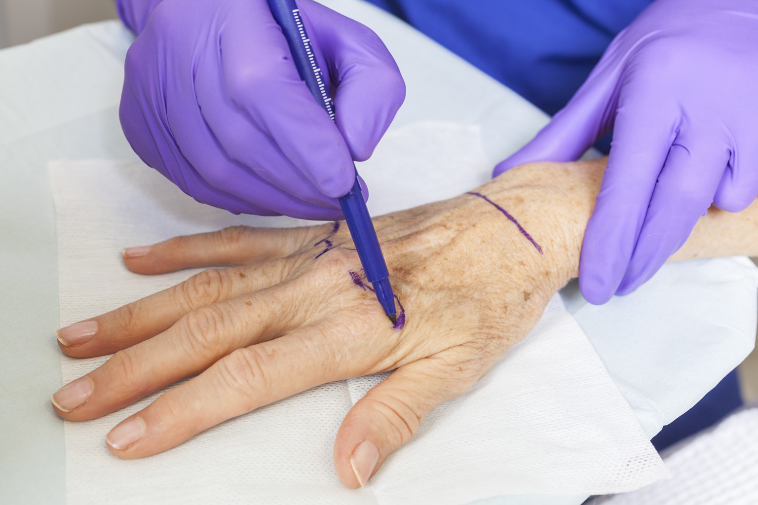 Hand Surgery and Replantation